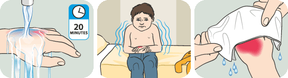 burn2 PIP-BurnsScalds-456-8161-1439001689.gif