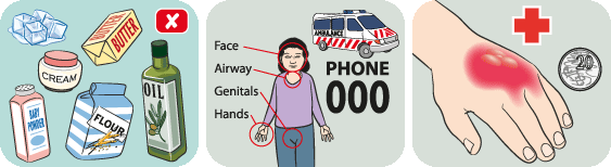 burn3 PIP-BurnsScalds-789-2611-1439001689.gif