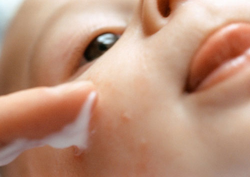 Mụn trứng cá ở trẻ, bác sĩ nói gì? 1 Mụn trứng cá ở trẻ, bác sĩ nói gì? 1